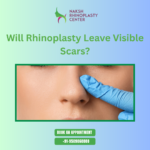 Rhinoplasty